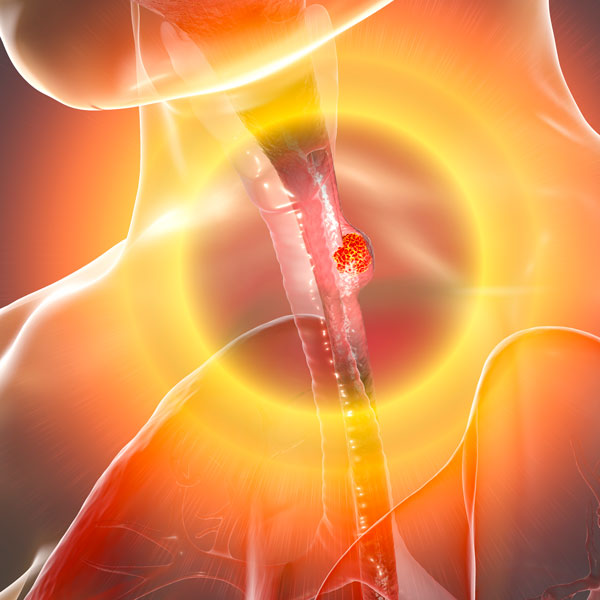 3D rendering of esophageal cancer